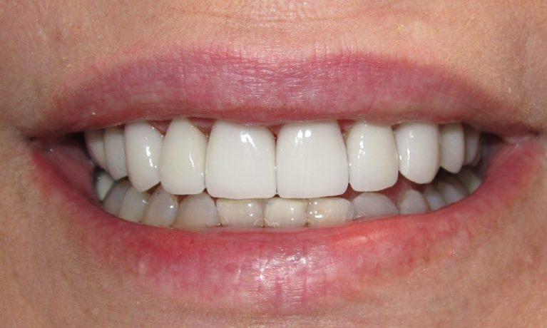 Smile-Makeover-After-Image
