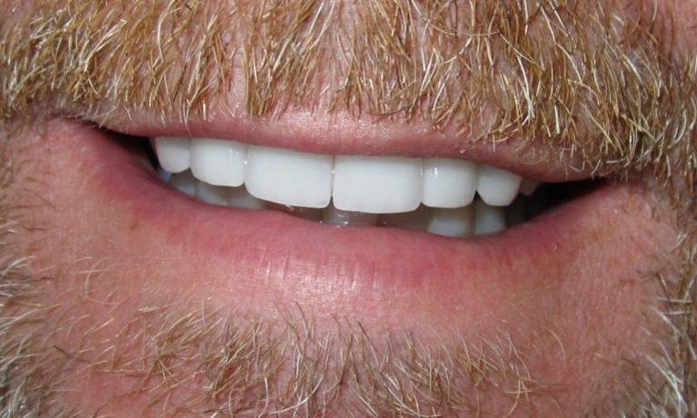 Smile-Makeover-After-Image