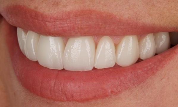 Upper-Teeth-Veneers-and-Single-Tooth-Implant-Crown-After-Image