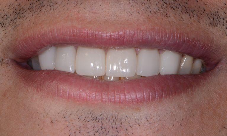 Veneers-After-Image
