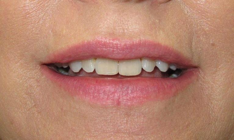 Smile-Makeover-Before-Image