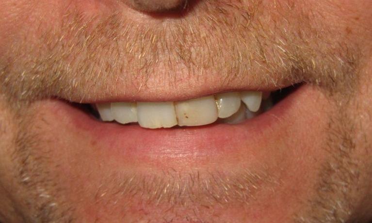 Smile-Makeover-Before-Image