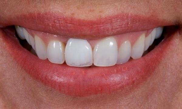 Upper-Teeth-Veneers-and-Single-Tooth-Implant-Crown-Before-Image
