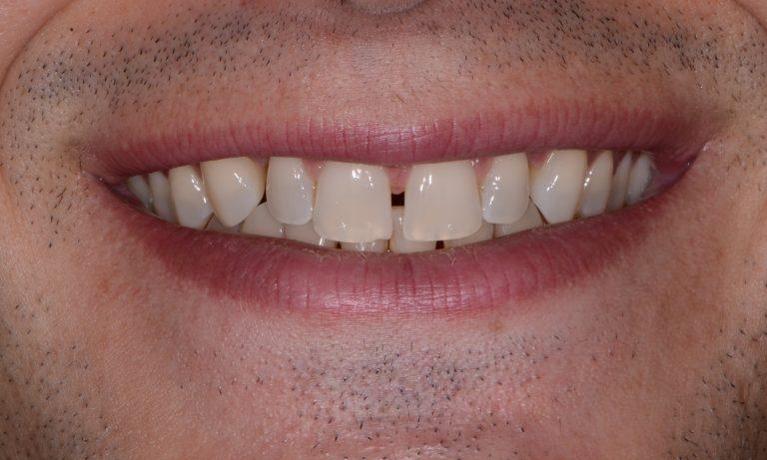 Veneers-Before-Image